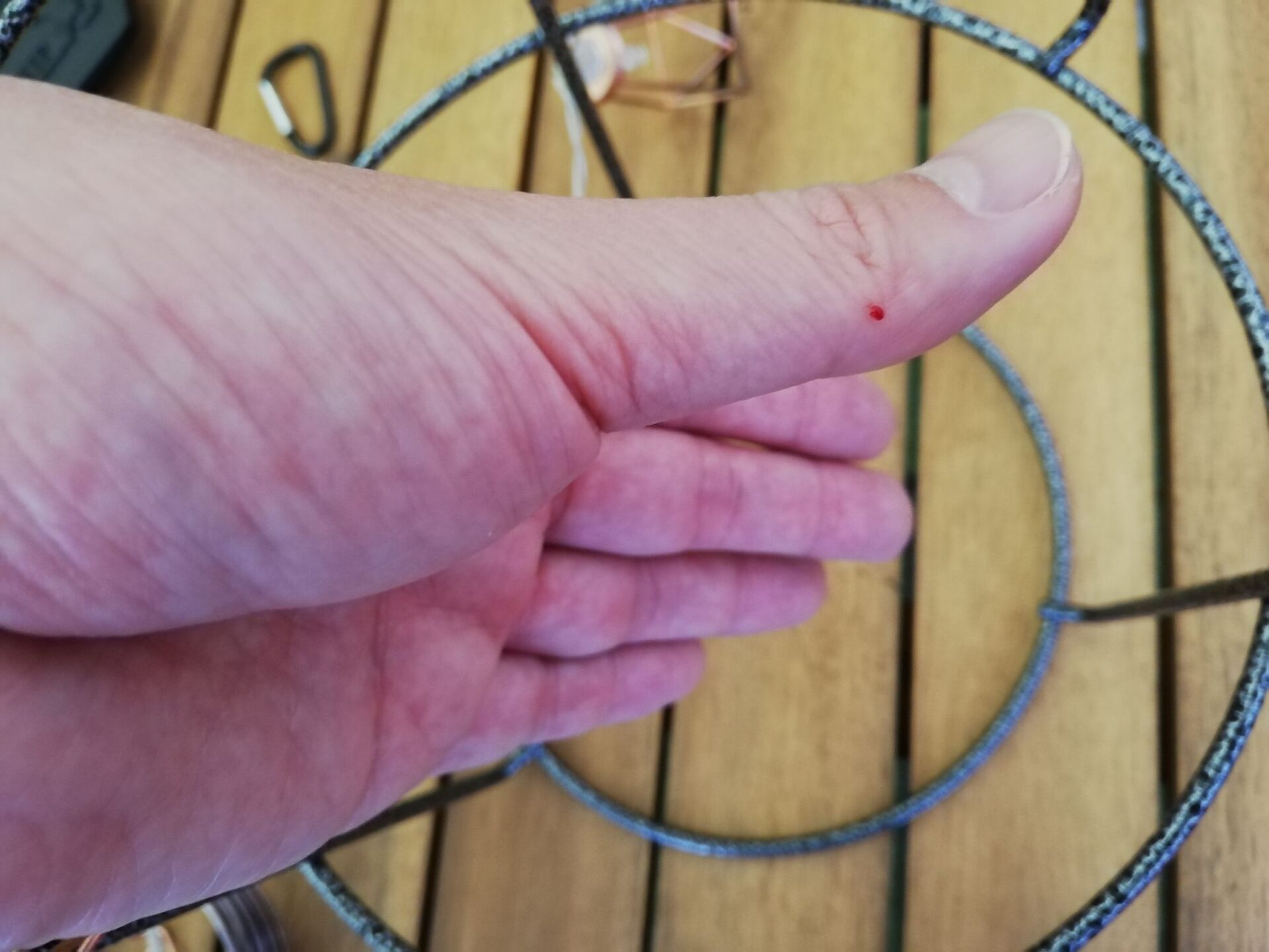 ワイヤーが手に刺さり出血